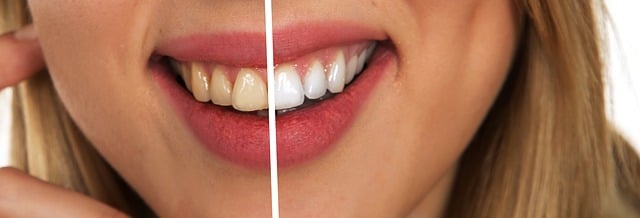 Diş Yapıştırma Ne Kadar Sürer? Diş Yapıştırma Ne Kadar Sürer?